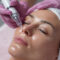 microneedling pompano beach