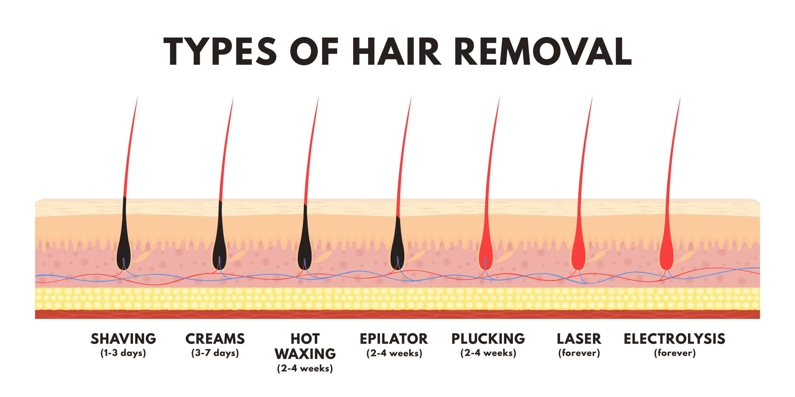 Chart comparing types of hair removal: shaving, creams, waxing, epilator, plucking, laser and electrolysis