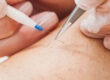 Electrolysis hair removal treatment in Pompano Beach
