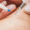 Electrolysis hair removal treatment in Pompano Beach