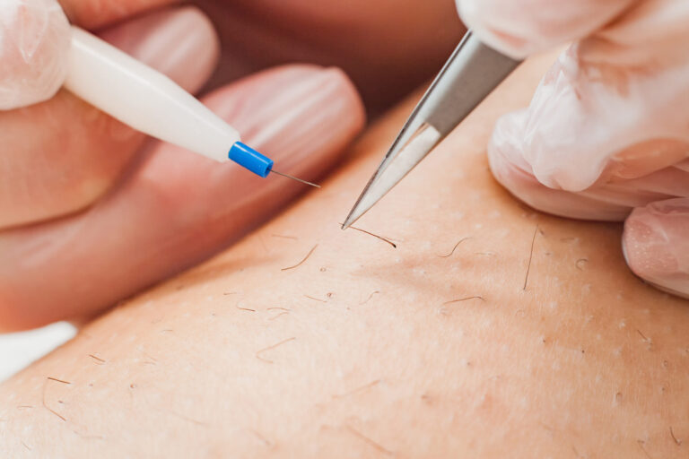 Electrolysis hair removal treatment in Pompano Beach