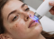 IPL treatment for hyperpigmentation on a client's face in Pompano Beach, FL
